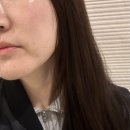 [서울피부과] 여드름흉터시술, 요철 피부관리 전문 한의원 2회 후기