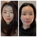 프라임한방병원 | 길음뉴타운피부과, 울쎄라프라임 300샷 + 리투오 내돈내산 후기 (효과,통증,가격)