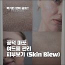Skin 25 | 마포여드름·공덕압출 전문 피부보기 Skin Biew｜등드름 압출 필링