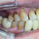 수자인치과의원 | 어디서 해야할 지 고민된다면? 청량리 전농동 제기동 용두동 임플란트 경험과 후기가 많고 a/s 잘되는 치과