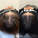 엠두피엔아트월드 | 가르마커버 두피문신 후기｜고양시 능곡·행신·화정 고객 추천