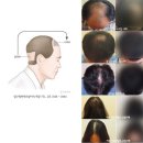 모발을 채우다 이미지