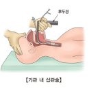 가습기 살균제 연관 폐질환 ＜Humidifier disinfectant-associated lung injury＞ 이미지