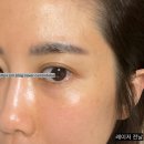 어바인피부과의원 | (여의도피부과) 어바인 피부과 색소레이저 후기<피코슈어>