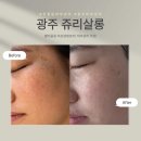 광주 기미 주근깨 잡티고민 진월동피부관리 추천 쥬리살롱 멜라올킬 후기