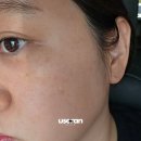동그라미 한의원 | 대구 중구 여드름 흉터 한의원 참침시술 후기