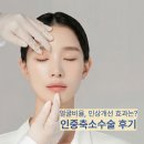 앵두미인 | 인중축소수술 후기 동안비율 인상도 달라질까요?