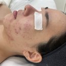 미왕 | 왕십리 피부관리 문제성피부관리 여드름 관리 만족 후기 [프롬미왕십리점]