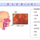 편도선염 이미지