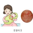 땀띠(Miliaria) 피부질환이란? 이미지