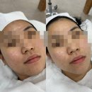 이엔뷰티 | [군산 지곡동] 이엔뷰티 여드름흉터 모공 엑소좀 플라즈마 피부관리 (비포애프터 有)