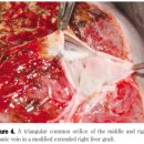 변형우엽을 이용한 생체간이식시 중간정맥 재건: 서울아산병원에서의 경험 이미지