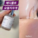 이븐메디칼 | 모공공주 집중! 메디폴트 요철지우개 여름에 쓰기 좋은 모공앰플 추천