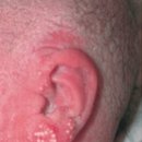 감염성 홍반(Erythema infectiosum) 이미지