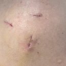 예스병원 | 회전근개파열 관절경 수술후 두달 경과 후기 /서울예스병원