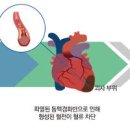 심혈관 질환 및 심근경색 증상과 원인 이미지