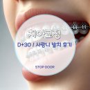 뽑고뽑고 | 치아교정 30일 사랑니 발치 후기 – 좌우 다 뽑고 난 생생 체험기