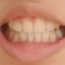 해다움 | 치아 교정 생각하고 있다면?꿀팁 포함(해다움&amp;아미->현 디원치과[신사동])