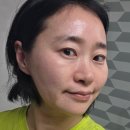 릴리의 생활공장 | 피부과］육아에 찌든 피부 탈출기! 릴리톡스 일주일 차 스킨보톡스 후기, 광명 피부과 더마톡신 추천...