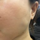 아주중학교 | 강남 피부과에서 사각턱보톡스 보툴렉스 후기