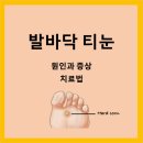 연성중앙약국 | 약국 티눈밴드로 발바닥 티눈 제거하기