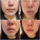 김해바른병원 | 김해 리쥬란힐러 잘하는 병원 추천 엠보 후기