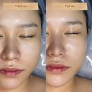 쏘닉 | [전주피부관리샵]르클레어 듀얼플라토닝 &amp; 듀얼물방울쏘닉 체험 후기
