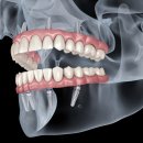 시흥햇살좋은치과의원 | 시흥 은행동치과_1. 틀니 대신 가능한 치료, 임플란트틀니란 무엇일까요?