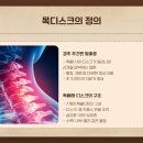 목디스크 증상 팔저림 관리법
