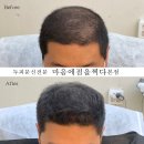마음에점을찍다두피SMP 이미지