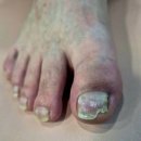 동성프라자 | 내성발톱 본네일 동성제약 풀리메디 문제성 발관리 방문 후기