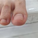 반복되는 발톱통증, 대전내성발톱 전문관리로 근본부터 교정하자