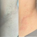 반송동153 | [예쁜왁싱]동탄 여성 겨드랑이왁싱 실제 후기🌟