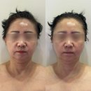 설아미 | 의정부피부관리 설아미 의정부본점에서 윤곽관리 받고 온 후기