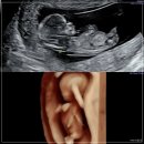 삼성1차 | 임신 12주 4일｜아산 삼성미즈 1차 기형아 검사, 입체 초음파 후기