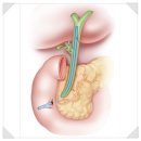 담도가 막힐 경우 시술하는 담관 스텐트 설치술(Biliary Stent Insertion) ​ 이미지