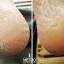 나도손톱 레푸스 개봉점 이미지