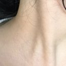 서울가정의학과의원 | 대구 가성비 평편사마귀 제거 전문 신세계가정의학과의원 흉터 후기