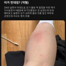 계명대 빈대 발생후 계속 늘고 있다는 피해자들 이미지