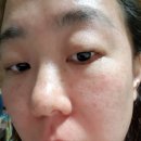 집에서기미없애는법》눈밑 기미를 간편하게 잡자!써모슈티컬 티로덤세트