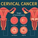 자궁경부 상피내 종양[cervical intraepithelial neoplasia] 이미지