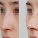 코원성형외과의원 | 화살코수술, 자연스러운 비주 올리기!(서울 치유성형외과)
