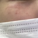 오리온피부관리실 | 피코슈어 피코토닝 줌패스 1회차 후기(내돈내산, 기미 색소 치료기, 부작용?)