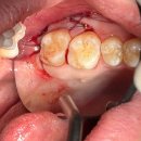 아산종합광고 | [아산 연세원치과]사랑니 뽑고 실밥 주변이 욱신거리는 이유