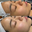 뷰티컴퍼니 소노엘 물방울리프팅 초음파 내돈내산 사용 찐후기