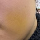 서울탑치과병원 | 서울대학교치과병원/ 매복 사랑니 발치 후기 with 수면마취