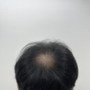 탈모왕 대구점 네이버블로그