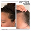 기대1 | 인천두피문신 그레이시티 인천직영점 1차 후기, 통증보다 기대가 컸던 정수리·헤어라인