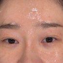 네오의원 | [공지] 청담 압구정로데오 피부과 네오페이스 리프팅 효과 후기