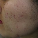 비비한의원 | 강남 여드름흉터 한의원 치료 후기